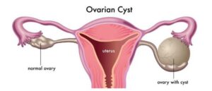 ovarian cyst